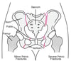 Pelvic Fractures