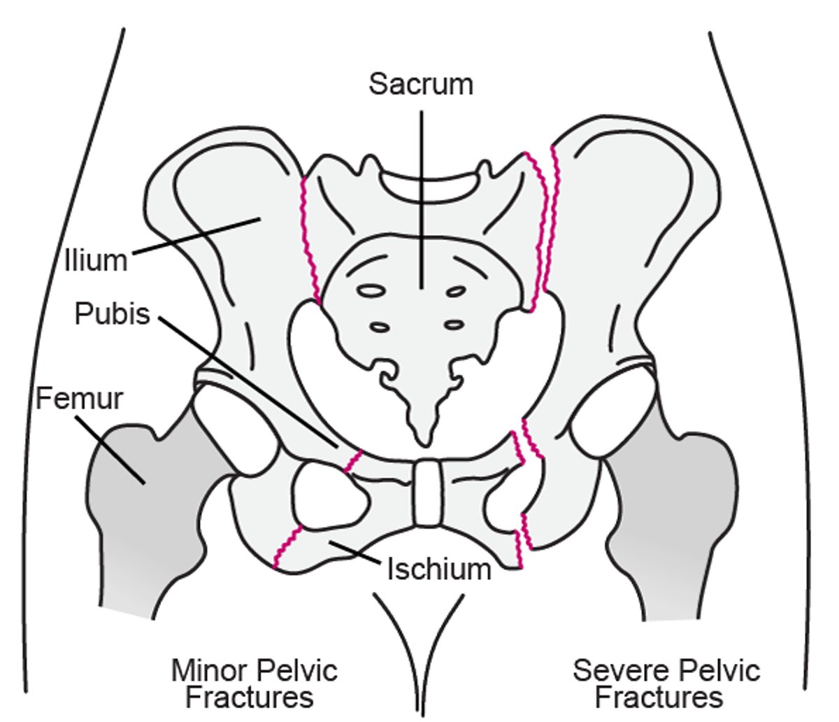 Pelvic Fractures