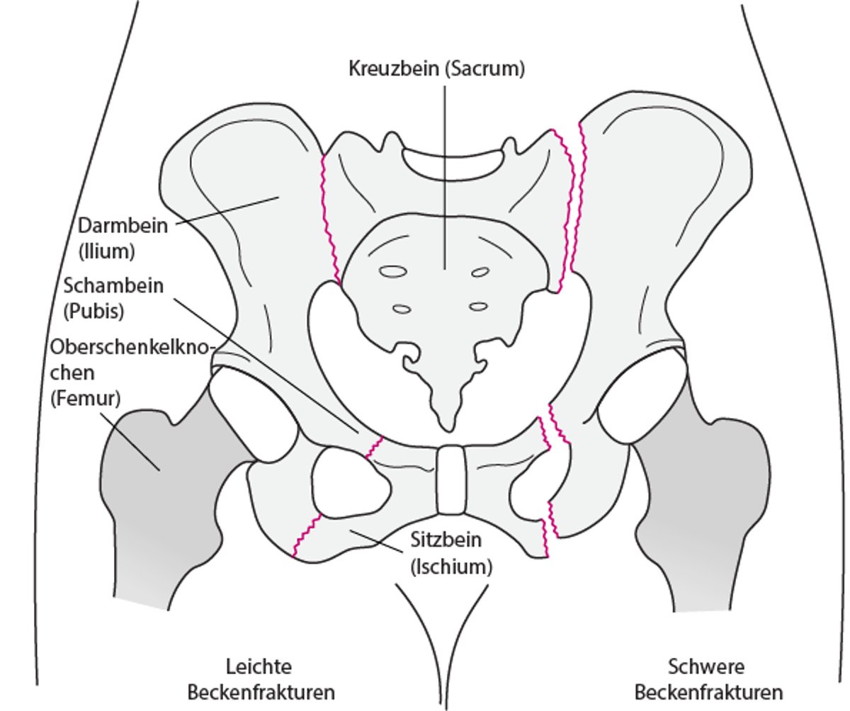 Beckenfrakturen