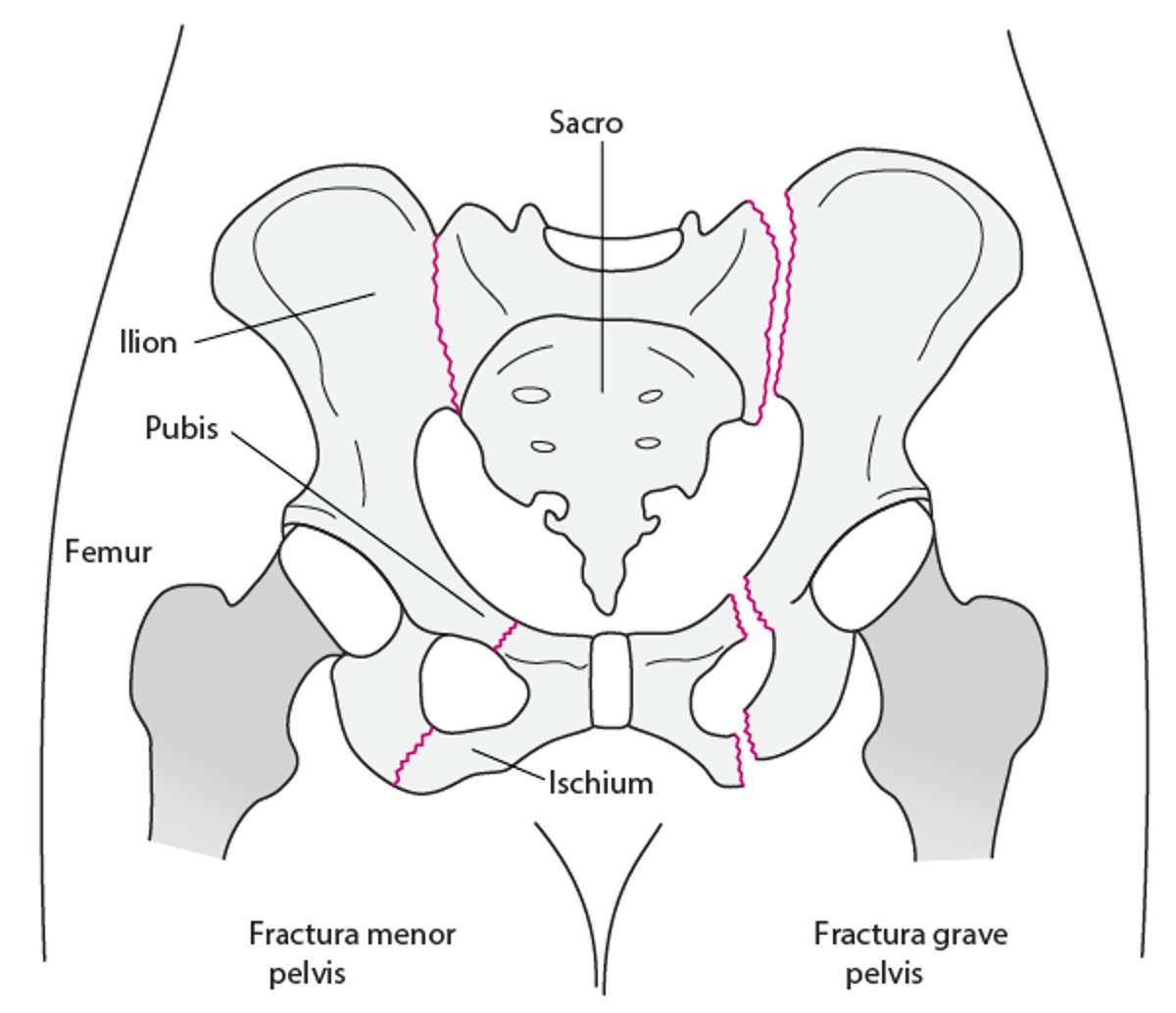 Fracturas de la pelvis