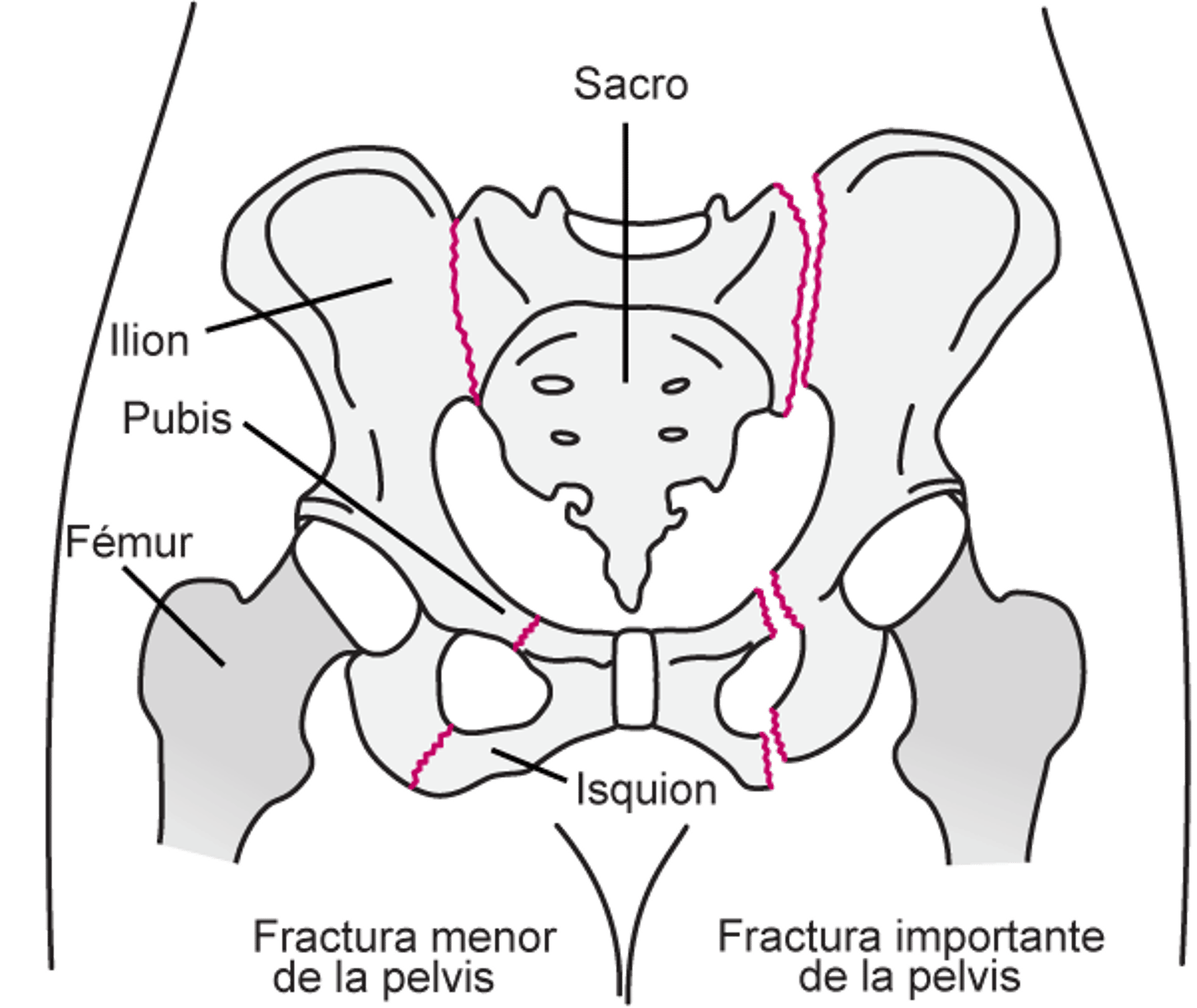 Fracturas de la pelvis