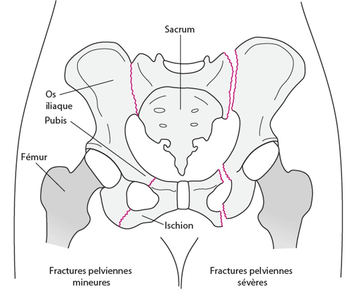 Fractures pelviennes