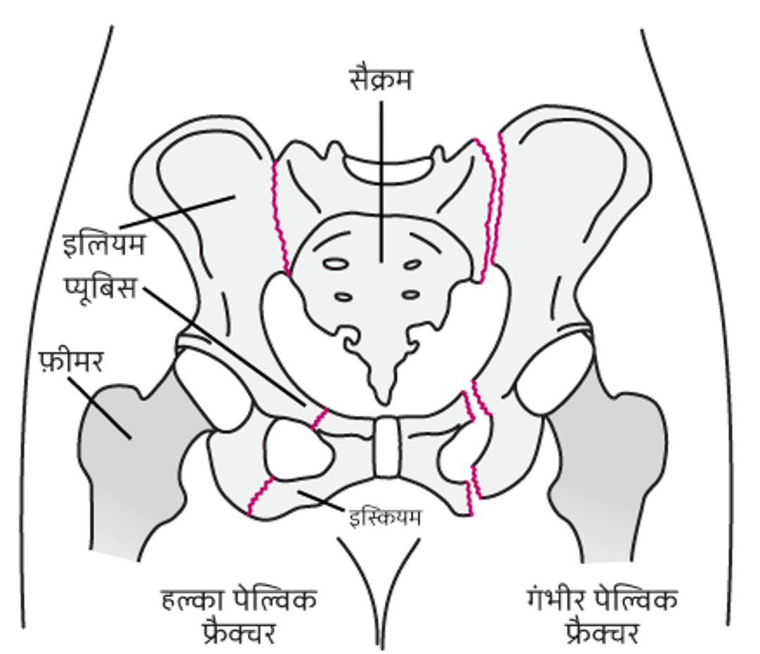 पेल्विक फ्रैक्चर