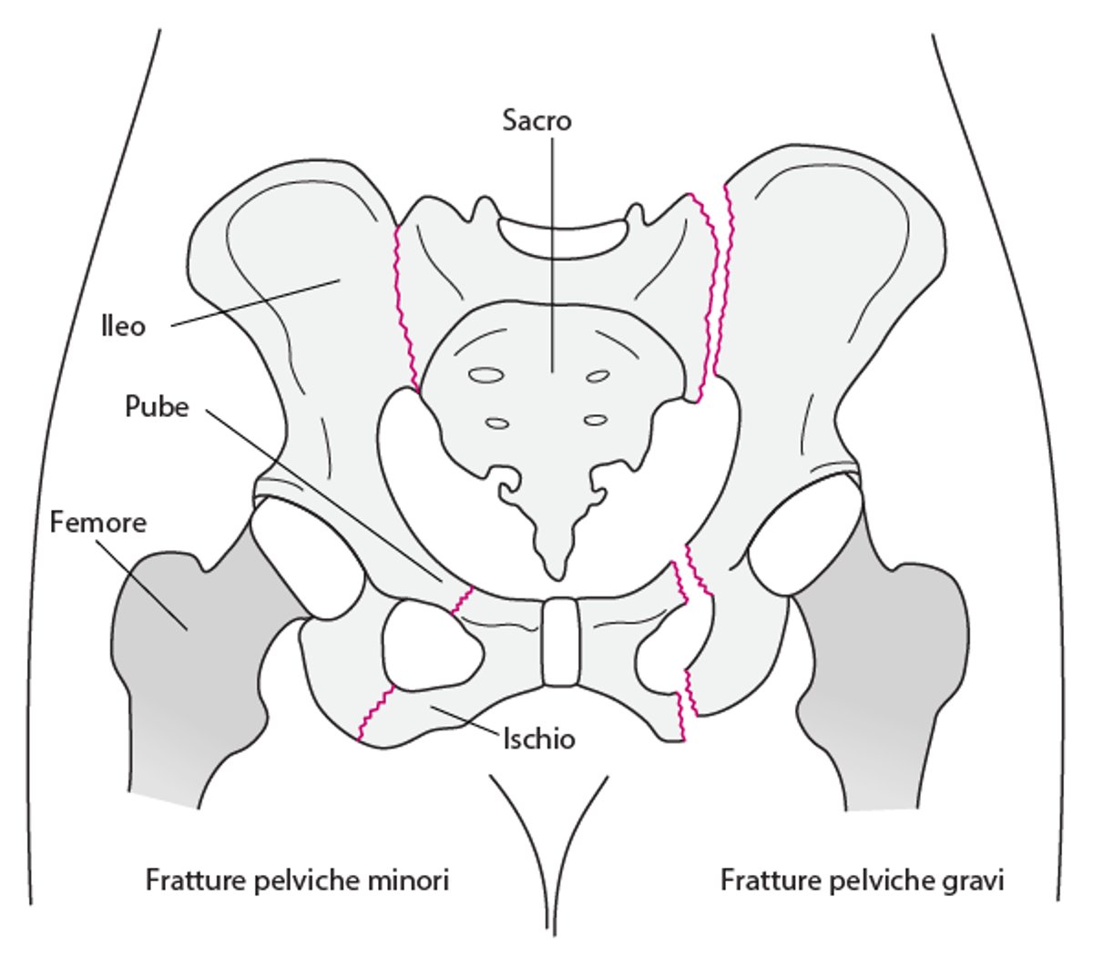 Fratture pelviche