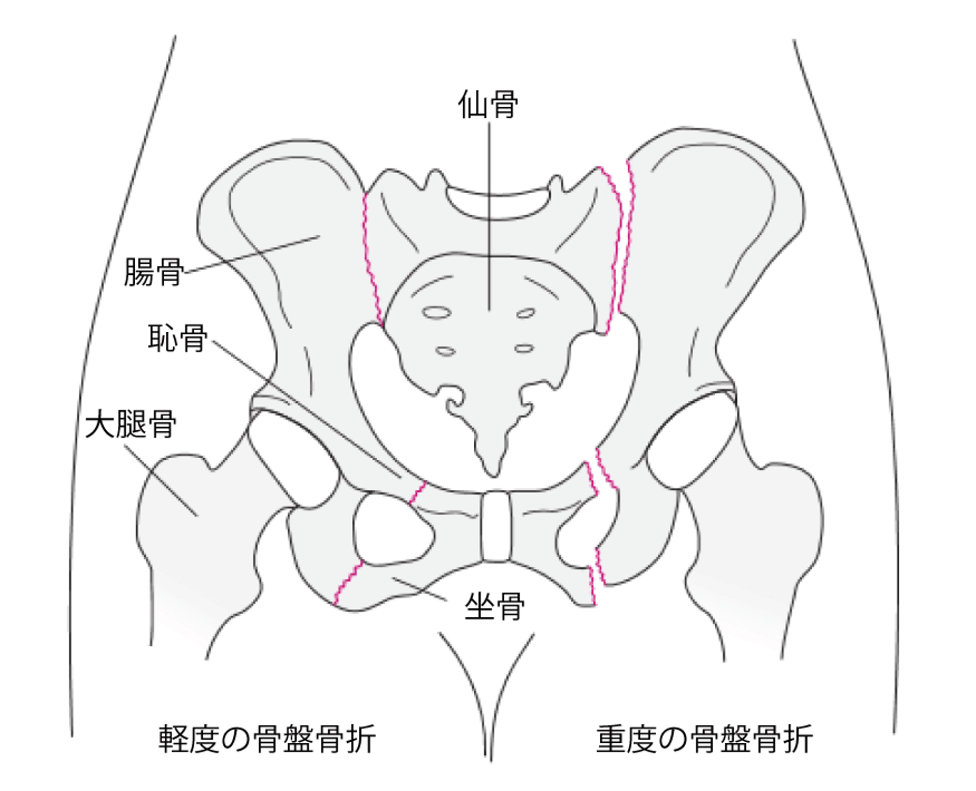 骨盤こつばんの骨折こっせつ
