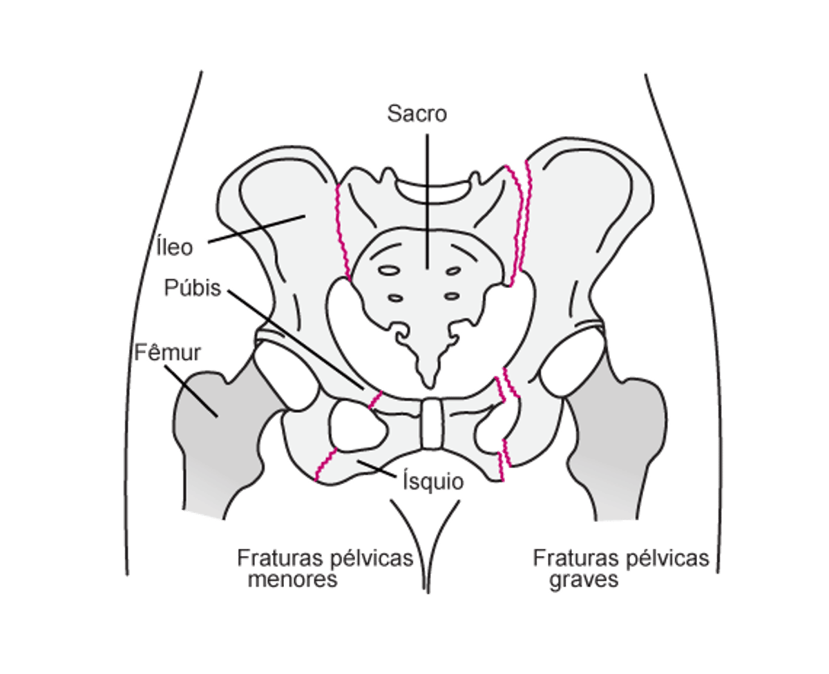 Fraturas pélvicas