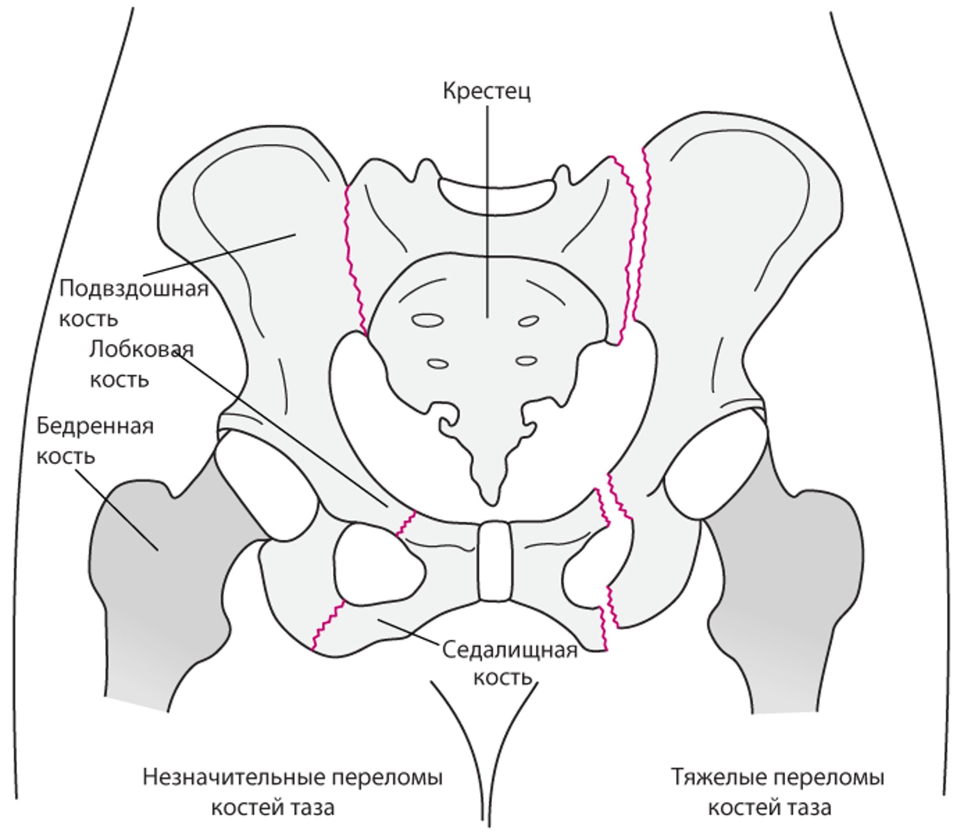 Перелом костей таза