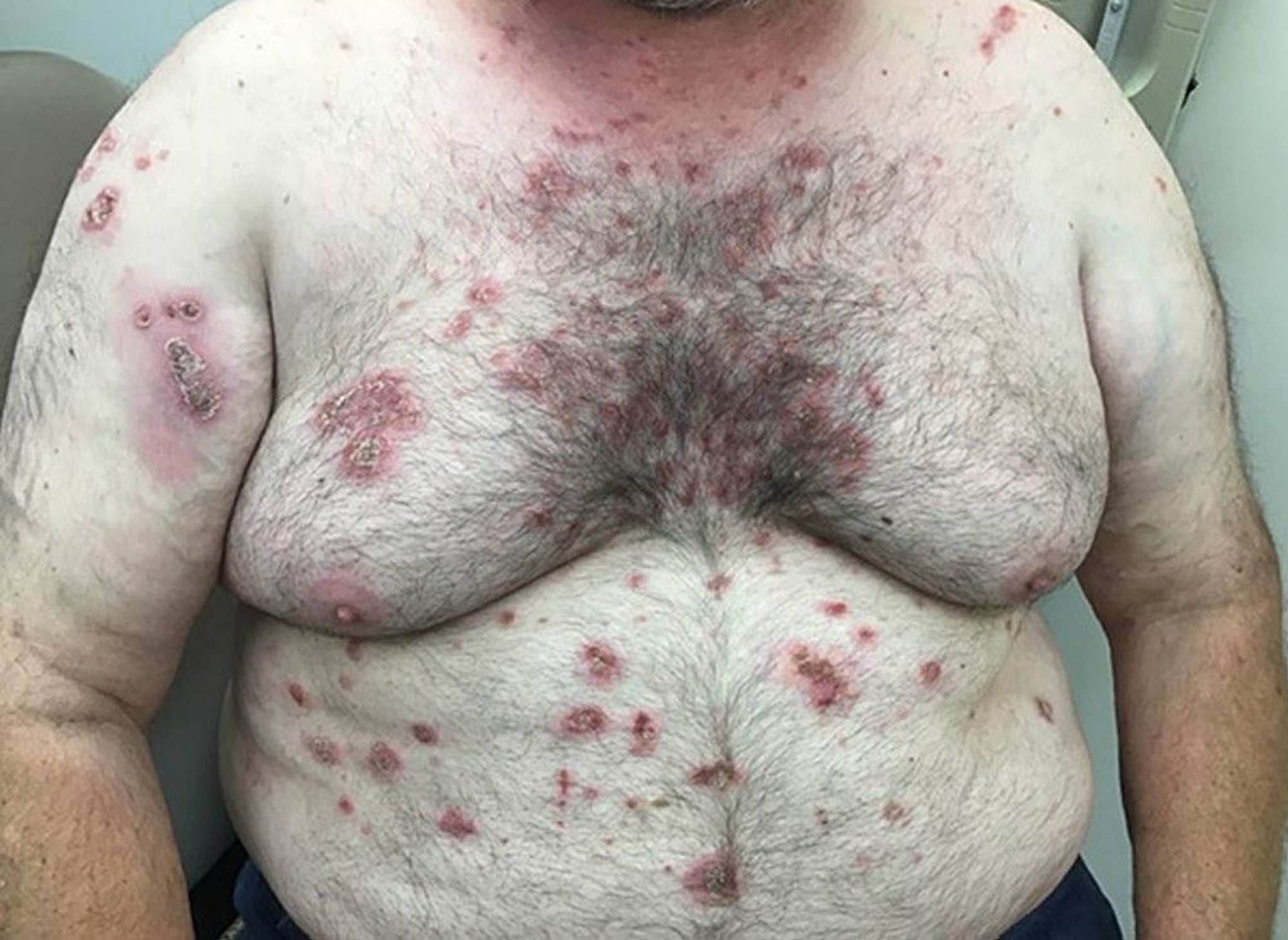 Pemphigus Vulgaris (Erosions)