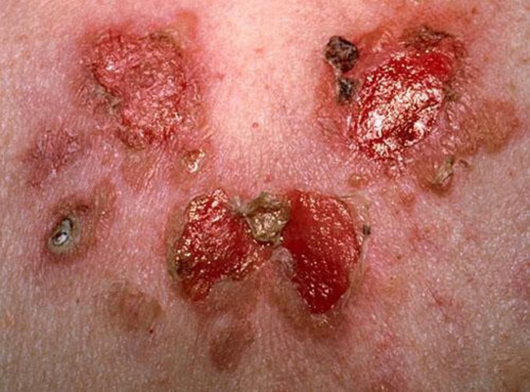 Pemphigus vulgaire (peau qui pèle et ulcérations)