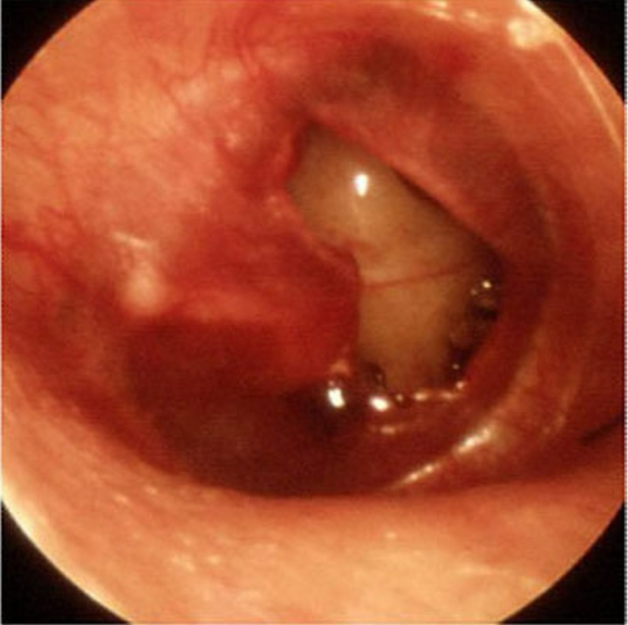 Perforation of the Eardrum