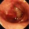 Perforation du tympan
