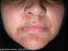 Perioral Dermatitis