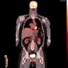 Positronen-Emissions-Tomografie/Computertomografie (PET-CT)