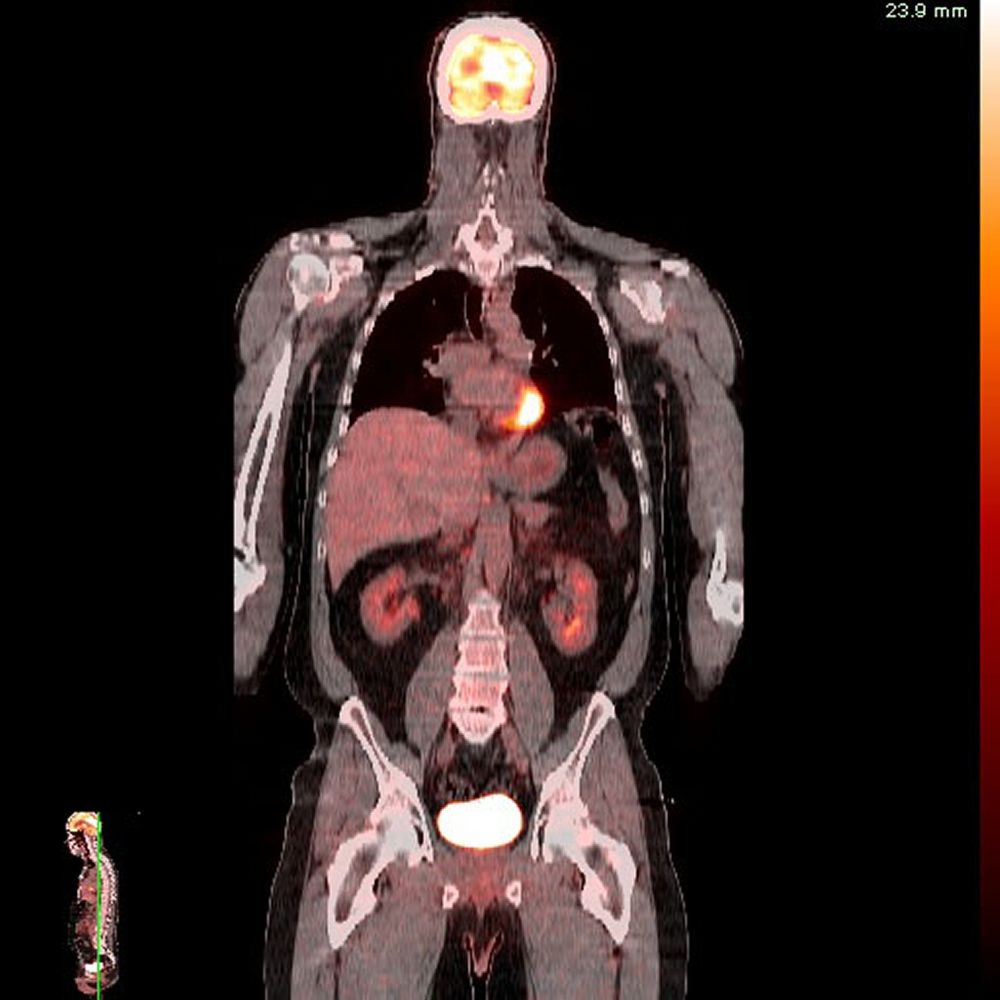 正电子发射断层成像-计算机断层成像（PET-CT）