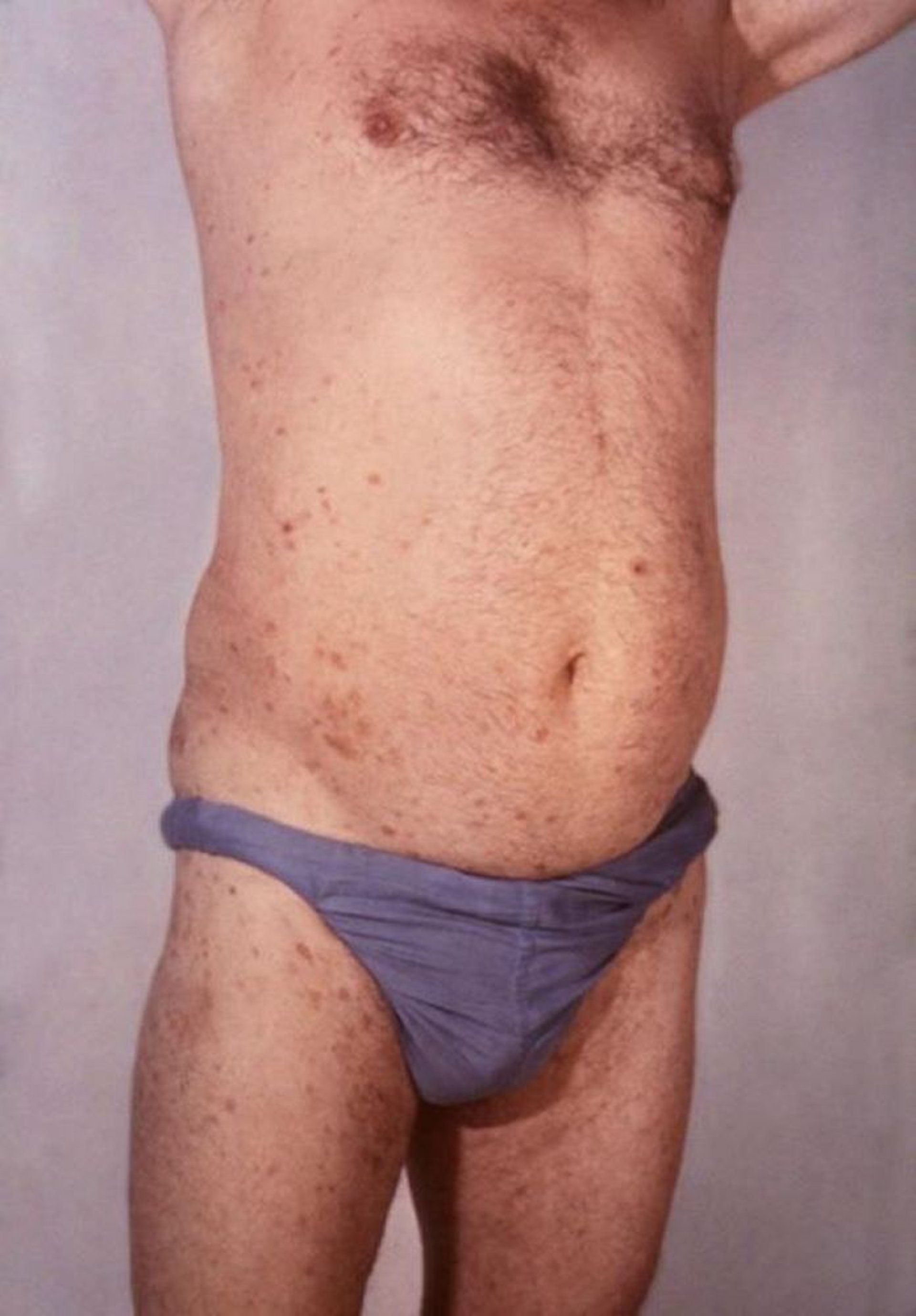 Small-Plaque Parapsoriasis