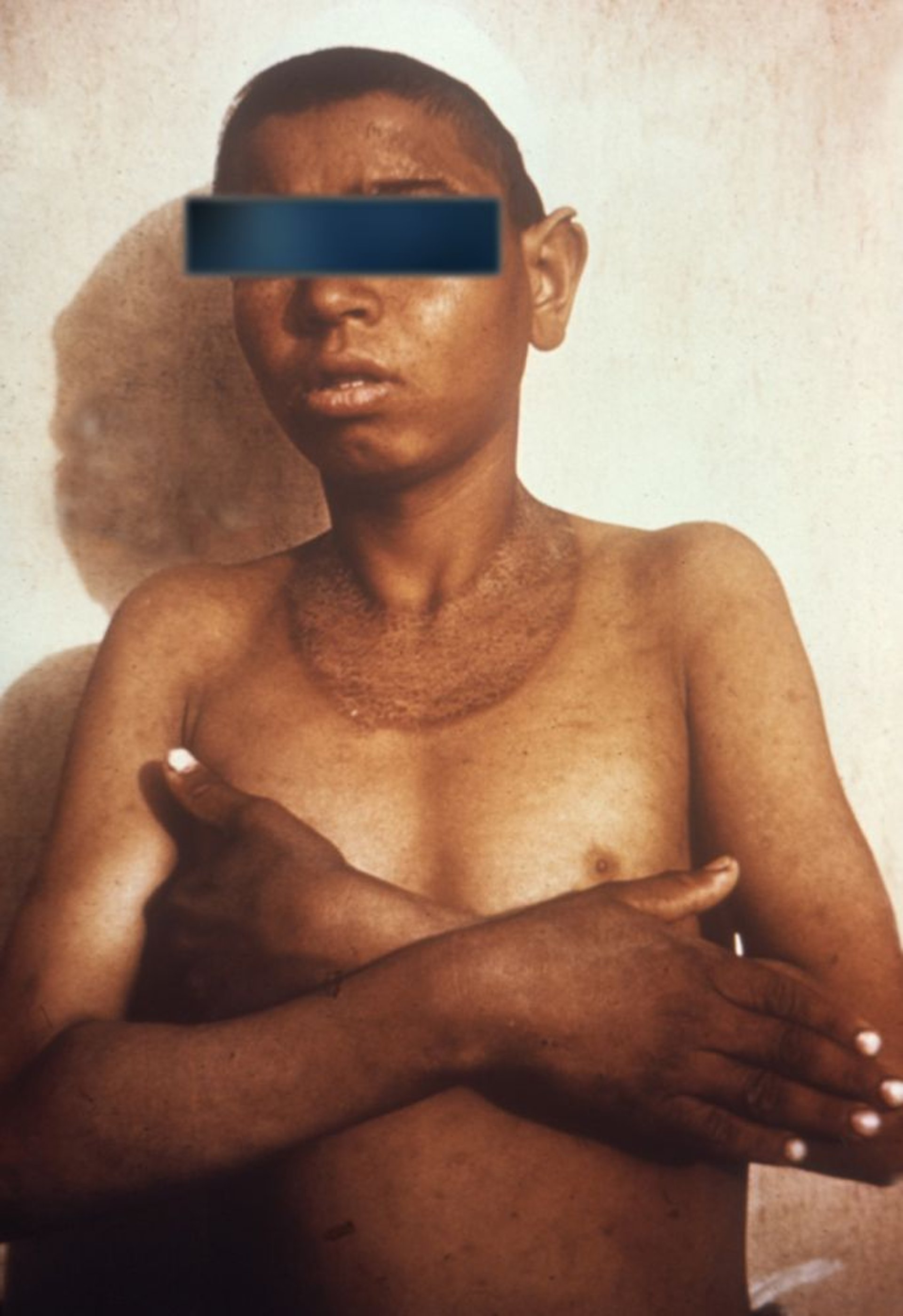 Erupción alrededor del cuello debida a pelagra