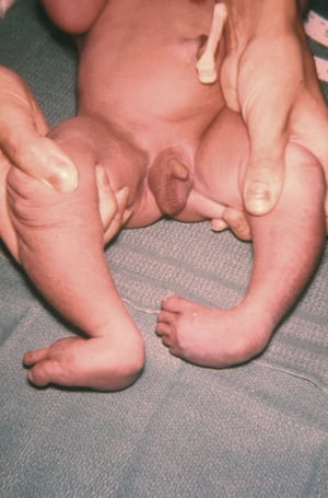 18번 삼염색체증에서 흔들의자 바닥모양 발