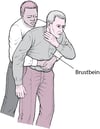Durchführung von Druckstößen in Richtung Zwerchfell (Heimlich-Handgriff)