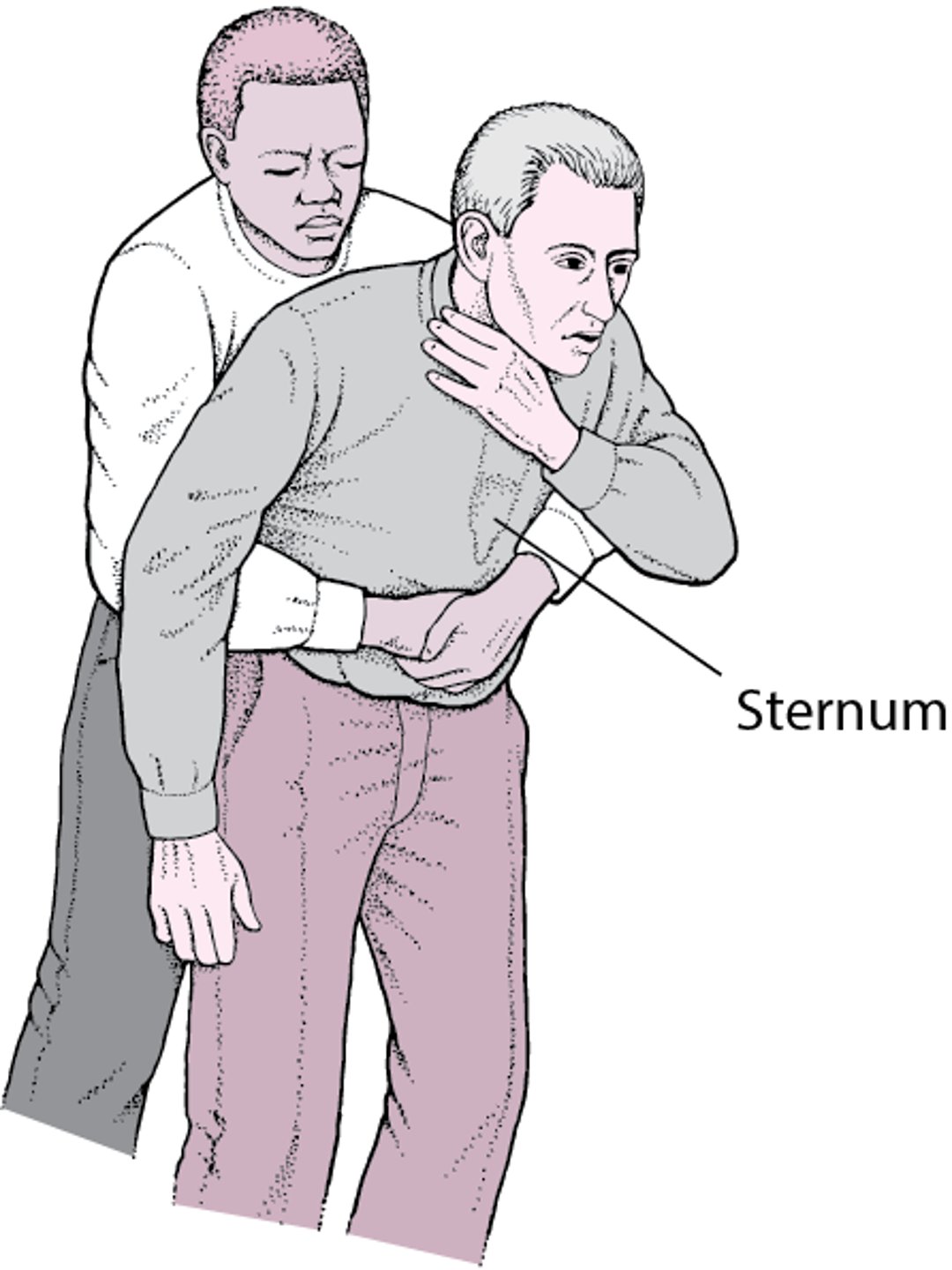 Poussées abdominales (manœuvre de Heimlich)