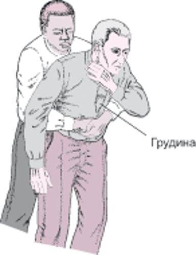 Выполнение абдоминальных толчков (приема Хеймлиха)