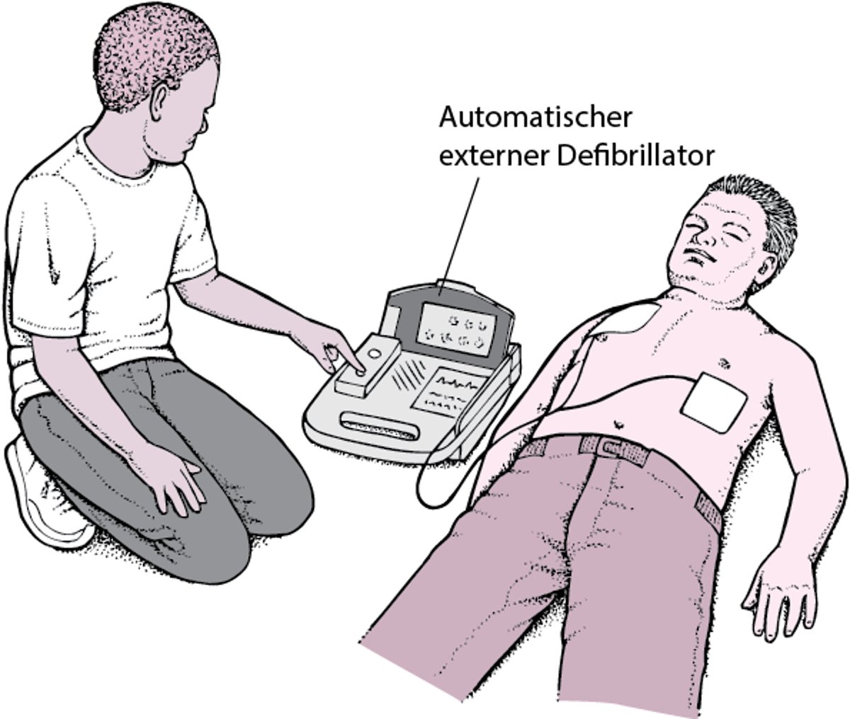 Automatischer externer Defibrillator: Fremdstarten des Herzens