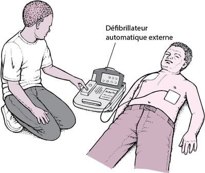 Défibrillateur automatique externe : Déclenchement des battements de cœur