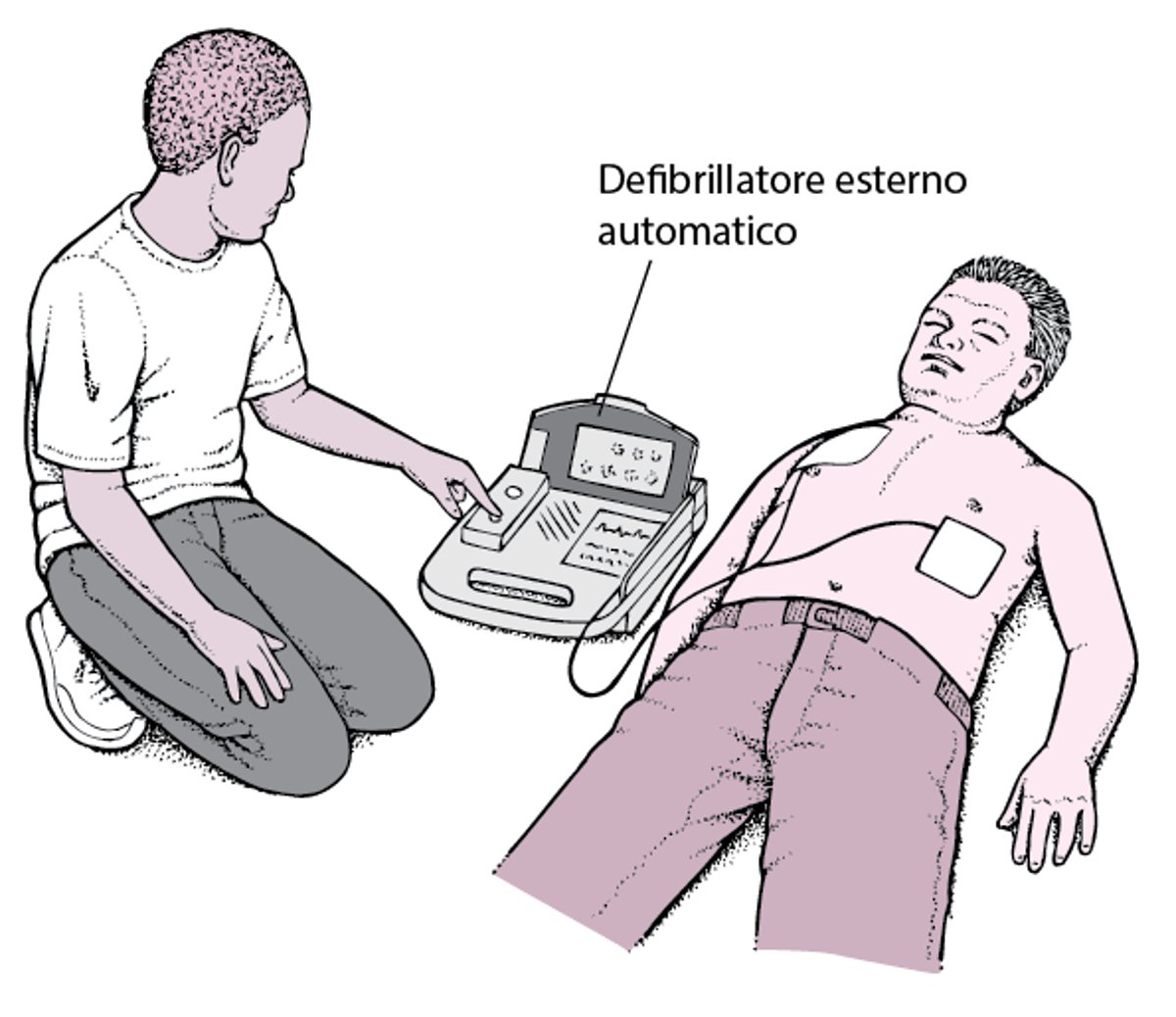 Defibrillatore automatico esterno: mettere in moto il cuore