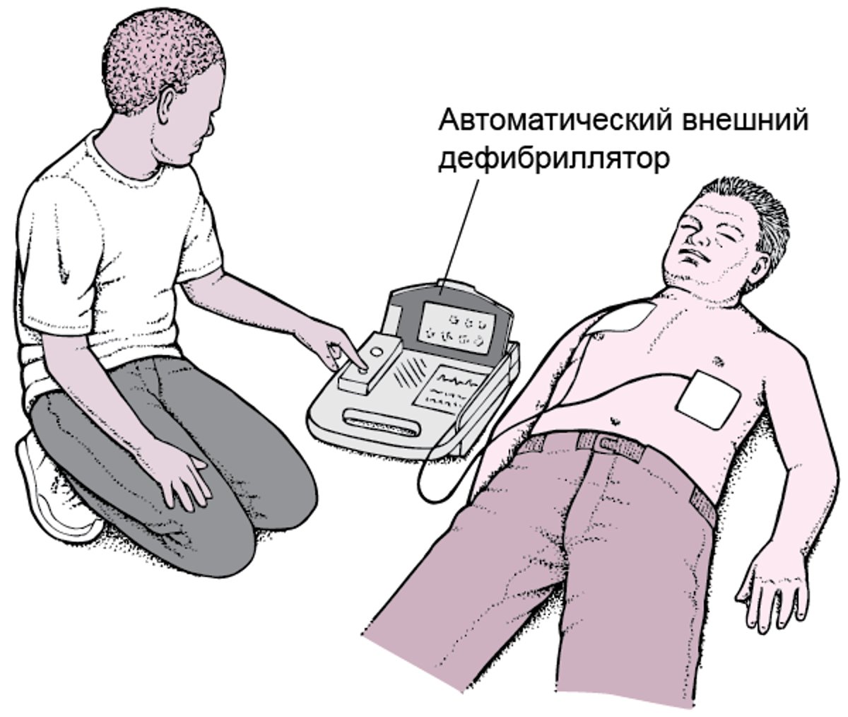 Автоматический внешний дефибриллятор: запускаем сердце «с толкача»