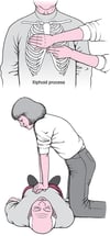 Doing Chest Compressions in an Adult
