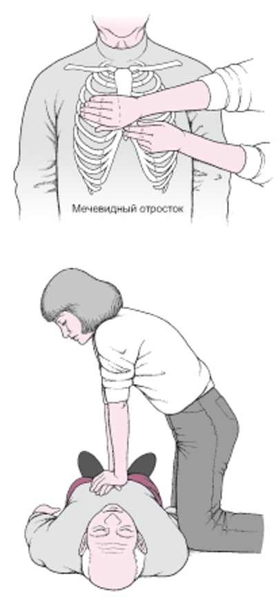 Выполнение непрямого массажа сердца взрослым