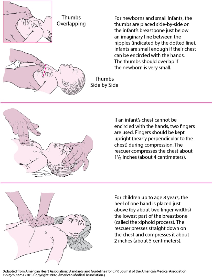 Cardiac Arrest and Cardiopulmonary Resuscitation (CPR) - Heart and ...