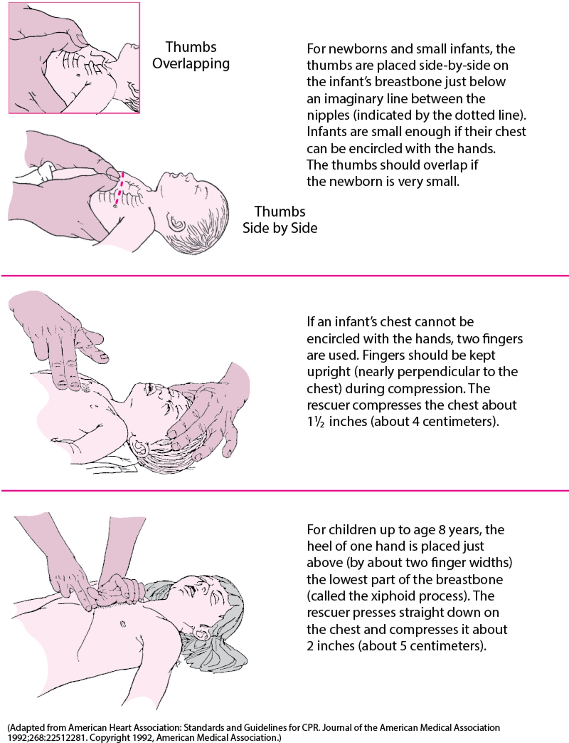 Doing Chest Compressions in an Infant
