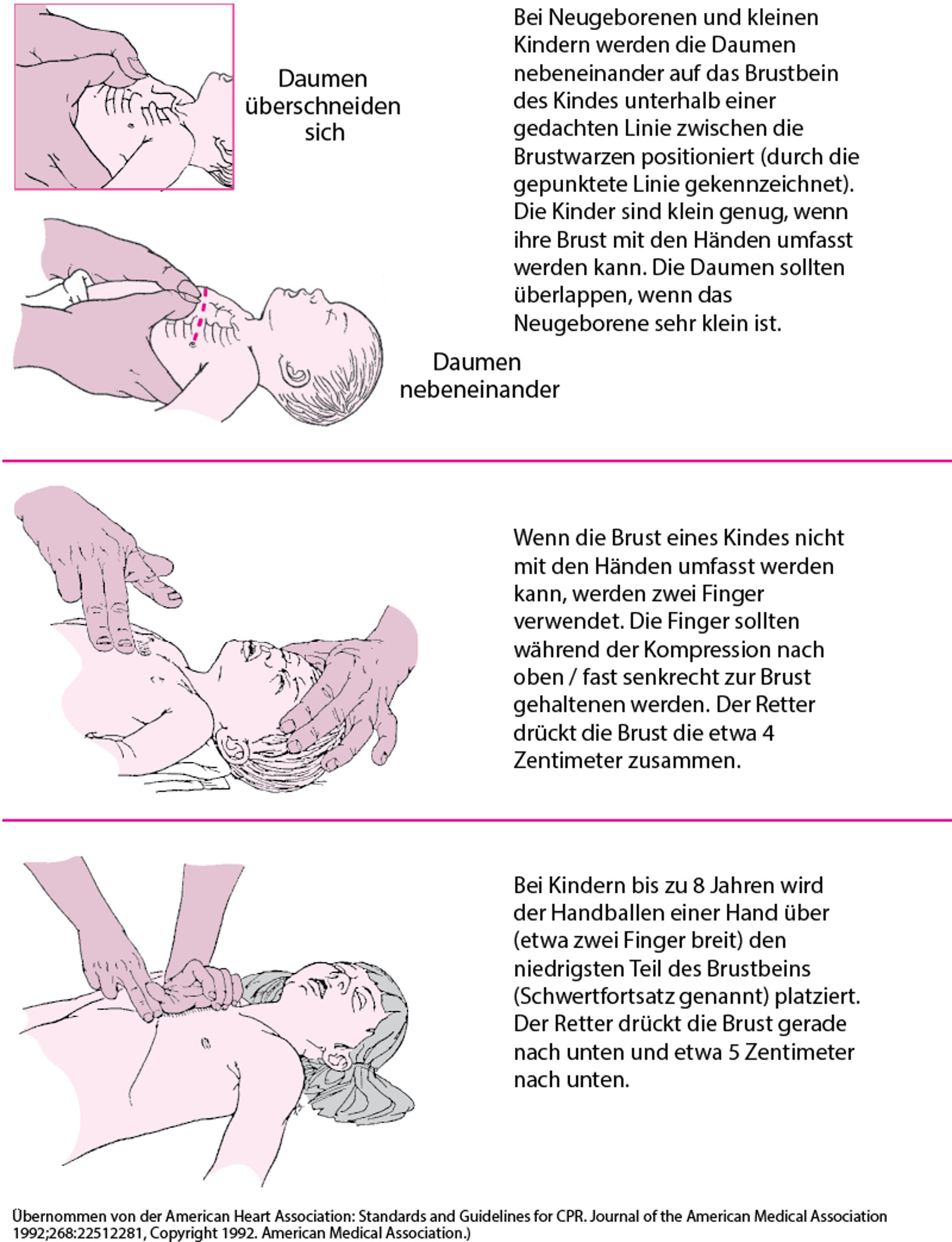 Herzdruckmassage bei einem Säugling