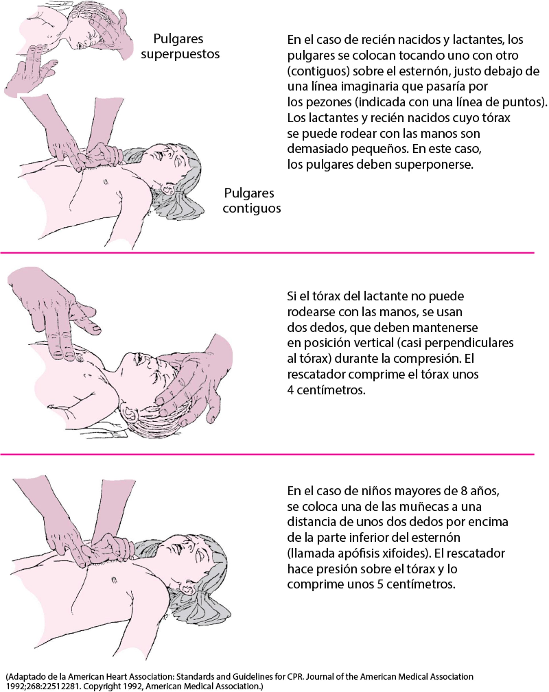 Compresión torácica a un lactante