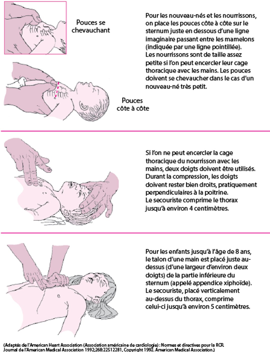 Pratiquer des compressions thoraciques chez un nourrisson