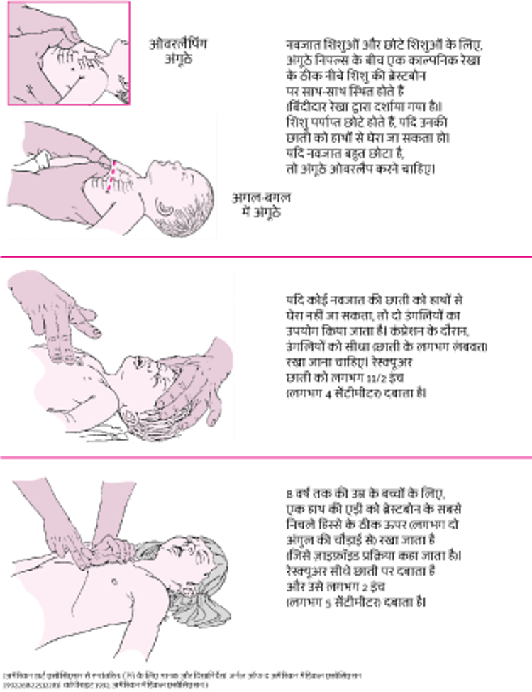 शिशु में सीने के कम्प्रेशन करना