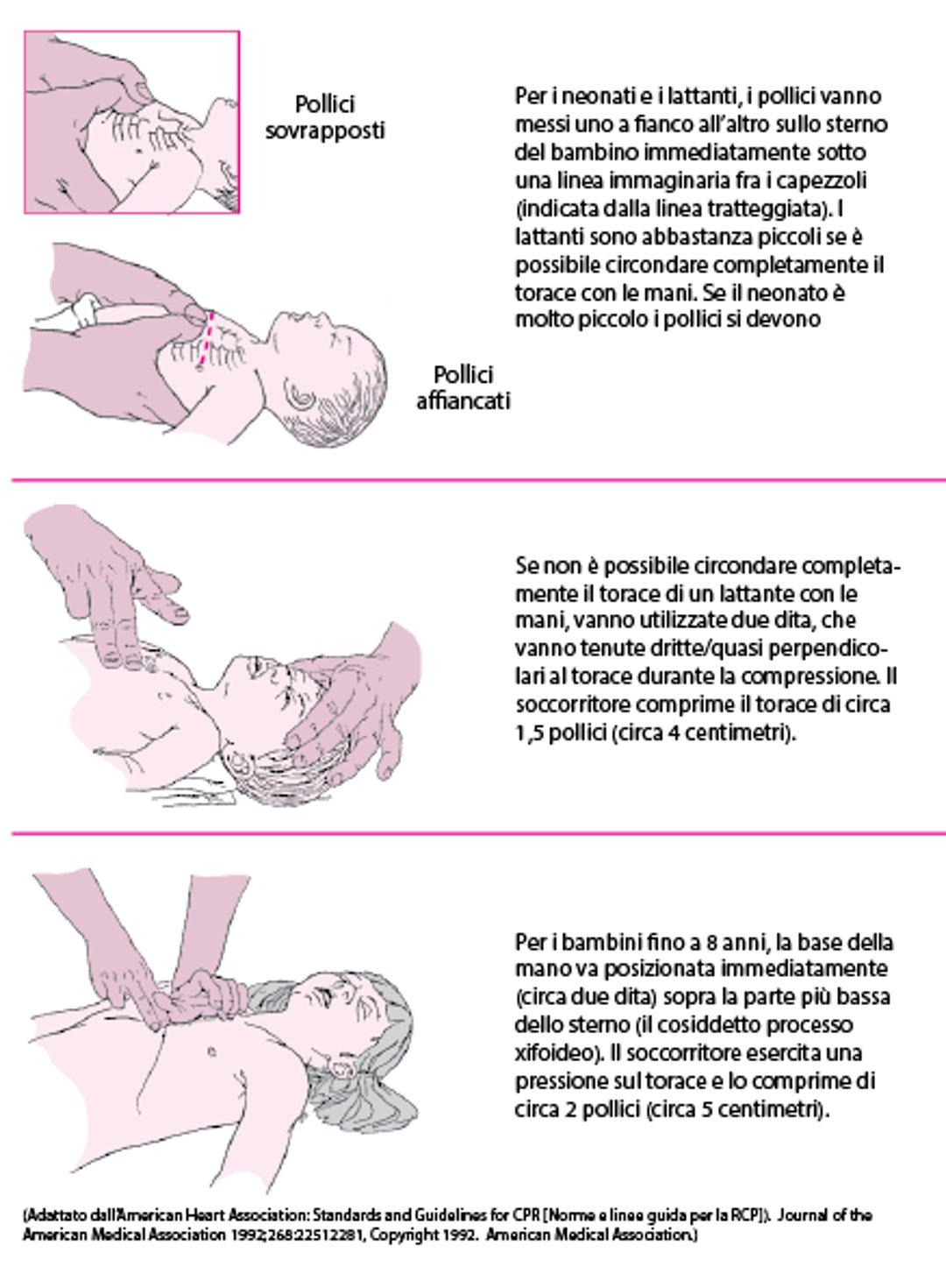 Come eseguire il massaggio cardiaco nei neonati