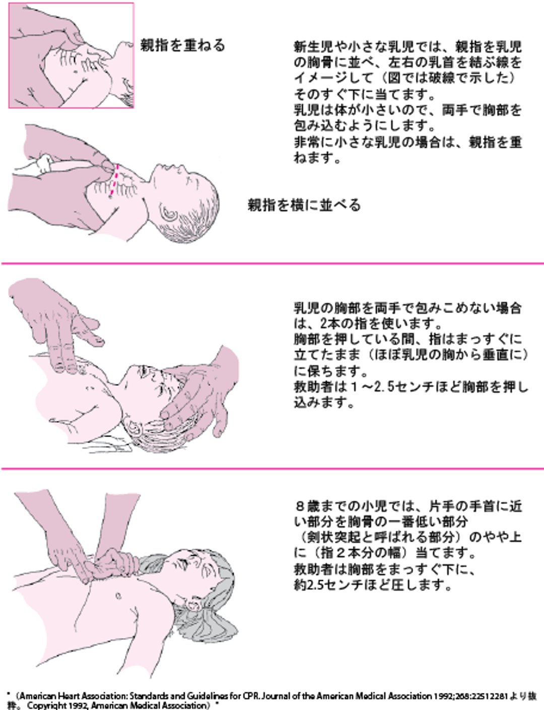 乳児に対する胸骨圧迫