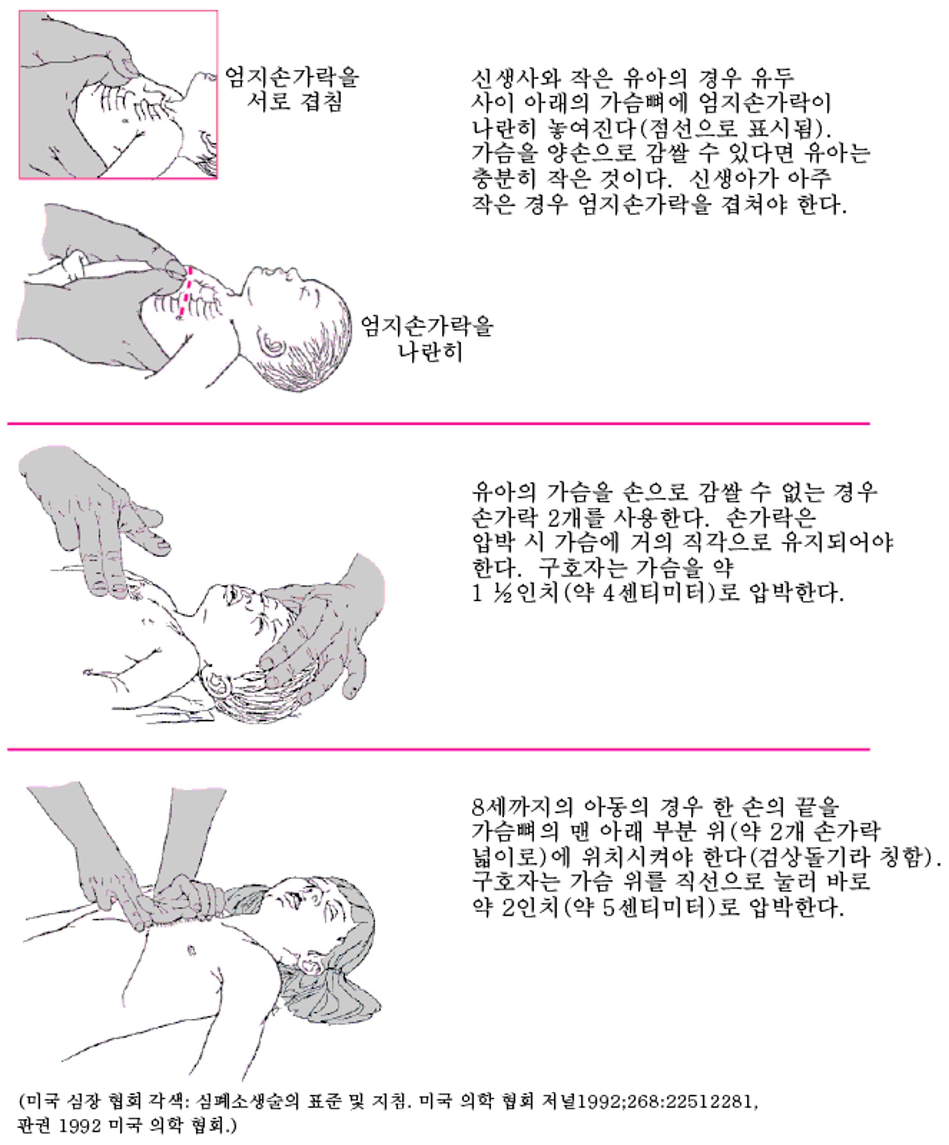 영아의 흉부 압박 실시