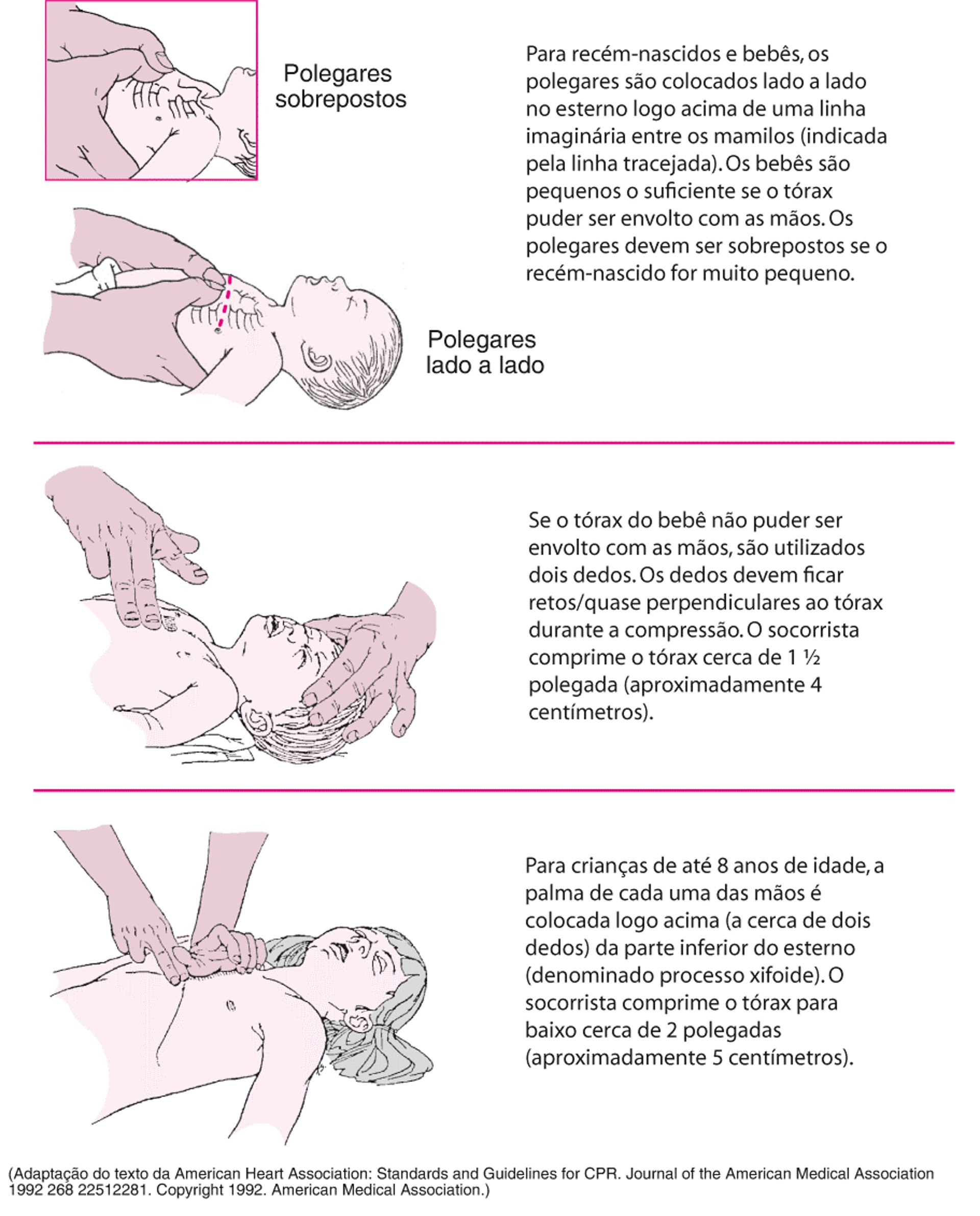 Realizar compressões torácicas em um bebê