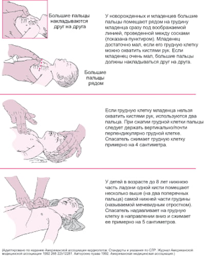 Выполнение непрямого массажа сердца младенцам