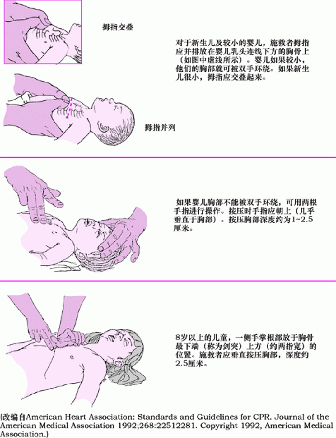 对婴儿进行胸外按压