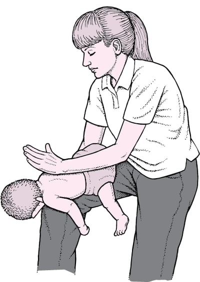 Clearing a Blocked Airway in an Infant