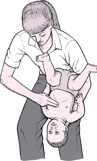 Clearing a Blocked Airway in an Infant