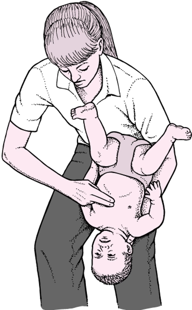 Extracción de un cuerpo extraño en las vías respiratorias de un bebé