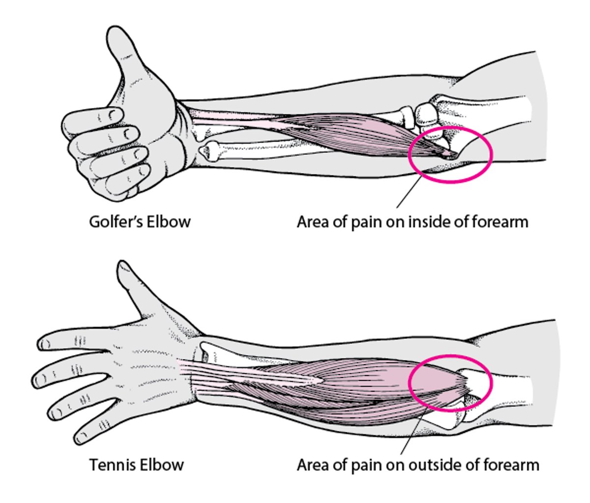 When the Elbow Hurts