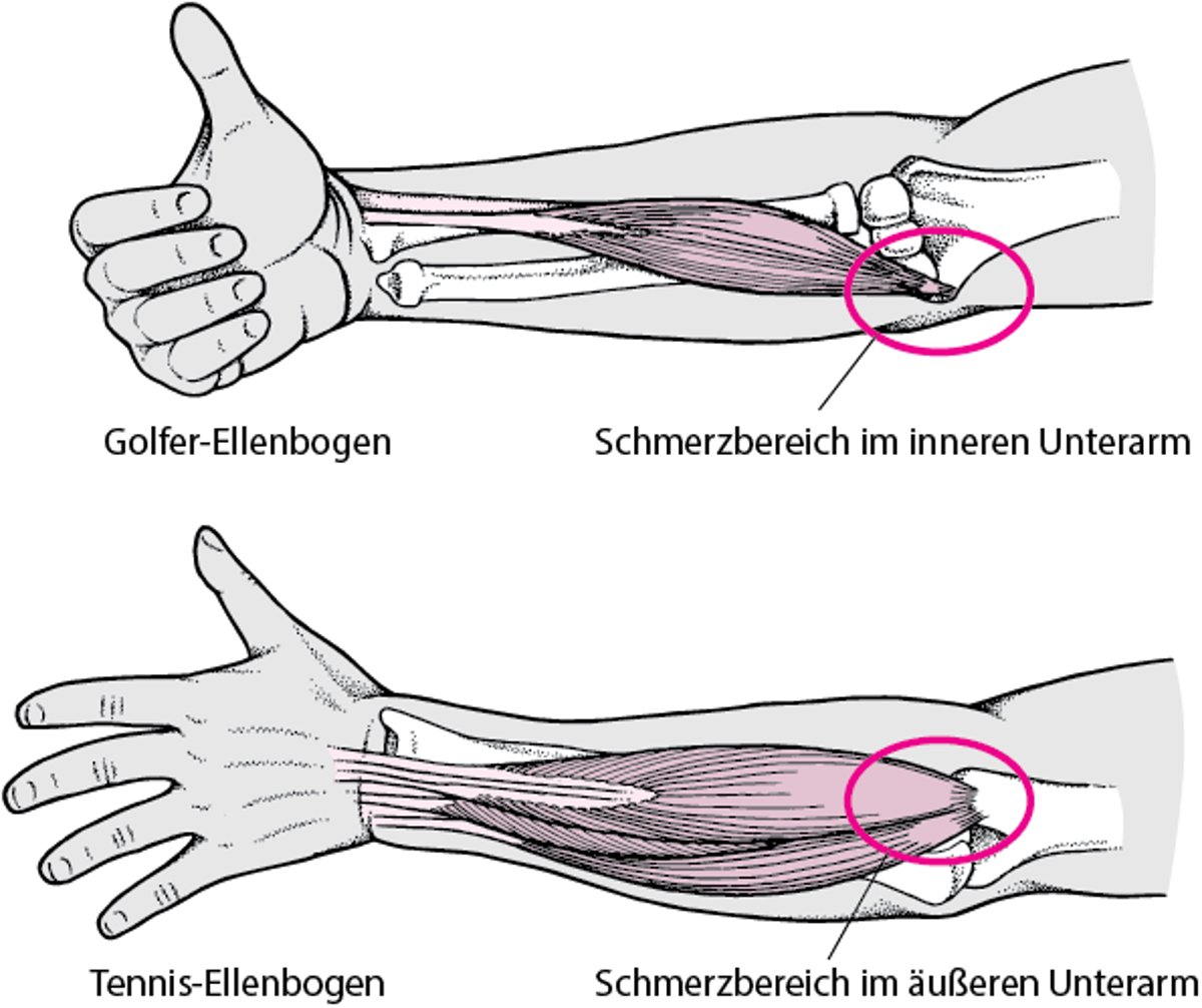 Wenn der Ellenbogen schmerzt