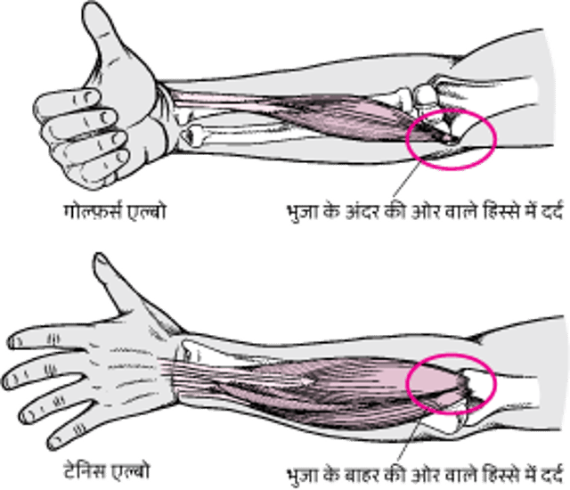 जब कोहनी में दर्द हो
