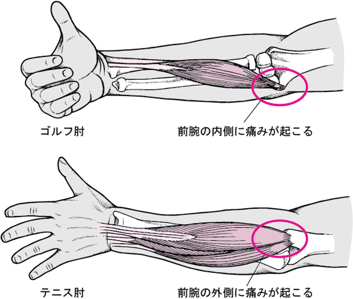 肘の痛み