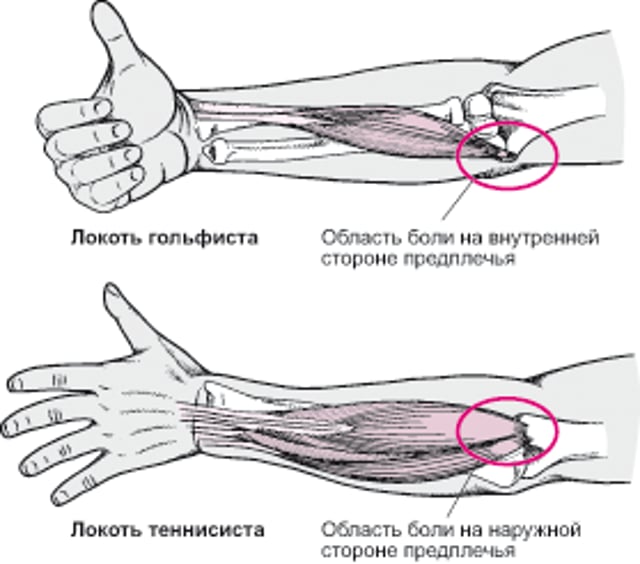 Когда болит локоть